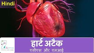 हार्ट अटैक एसीएस और एमआई  Heart Attack ACS & MI  Hindi