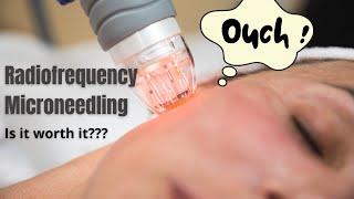 Radiofrequency Microneedling  Does it actually work?  Dermatologist reviews