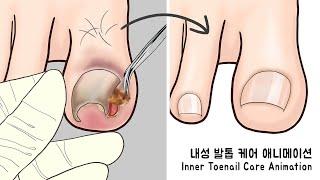 ASMR 시원함 주의 리얼한 내성 발톱 케어 애니메이션  Ingrown Toenail removal treatment animation