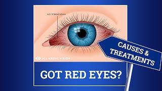 Red Eyes and Bloodshot Eyes Causes and Treatments