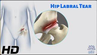 Hip Labral Tear The Hidden Culprit of Hip Pain