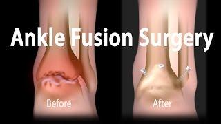 Ankle Fusion Surgery Animation