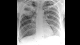 Mayo Clinic Minute Understanding tuberculosis