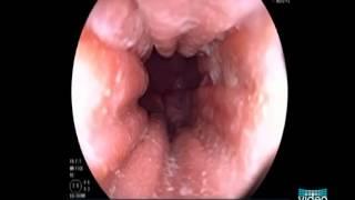 Endoscopic Appearance of Eosinophilic Esophagitis