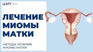 Лечение миомы матки. Методы лечения миомы матки. ЦЭЛТ