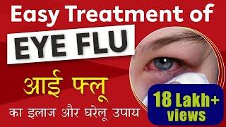 Eye Flu Treatment  Conjunctivitis - Cause Prevention & Treatment  आई फ्लू का इलाज और घरेलू उपाय 
