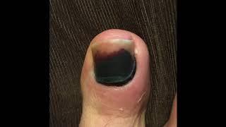 Dead Toenail Removal 892017