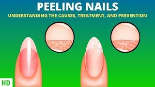Understanding Peeling Nails What Your Nails are Trying to Tell You