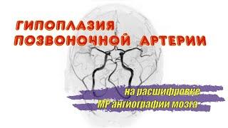 ГИПОПЛАЗИЯ позвоночной артерии и поперечного синуса на РАСШИФРОВКЕ МРТ ангиографии головного мозга