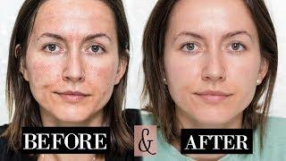 My MICRONEEDLING Experience + Skin Updates  Before & After