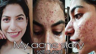My pimple story Part 1 treatment and causes  How to reduce pimples and pimple scars  Acne