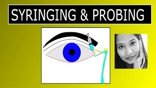 Lacrimal Syringing & Probing  Procedure & Interpretation of Results