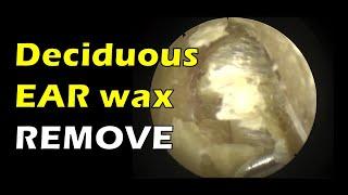 Deciduous EAR WAX removal