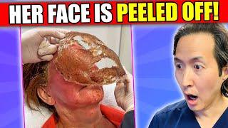 Plastic Surgeon Reacts to Face Peeling Off Videos #phenol peel