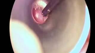 Ear Cleaning Video