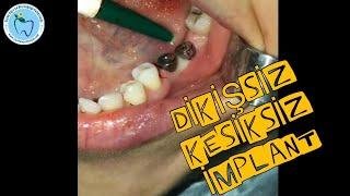 Dikişsiz implant tedavisi nasıl yapılır Flapless implant surgery