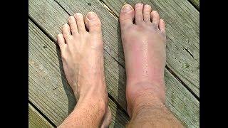SPRAINED or BROKEN Ankle?  *Doctor Guide*
