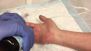 Steroid Injection for the Treatment of Trigger Finger