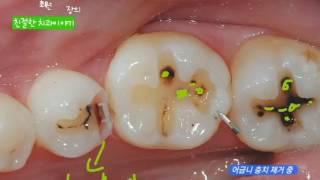 충치치료 어금니 충치치료과정 및 치료법  레진 인레이 때우기