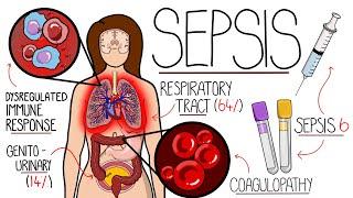 Understanding Sepsis Sepsis Explained Clearly