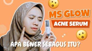 MS GLOW ACNE SERUM  Apa Bener Sebagus Itu?