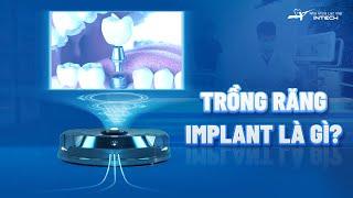 TRỒNG RĂNG IMPLANT LÀ GÌ?  KIẾN THỨC IMPLANT  NHA KHOA LẠC VIỆT INTECH