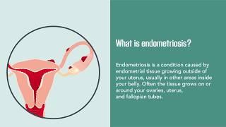 Endometriosis Causes Symptoms Diagnosis and Treatment  Merck Manual Consumer Version