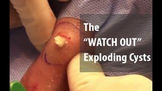 The WATCH OUT Exploding Cysts  Dr. Derm
