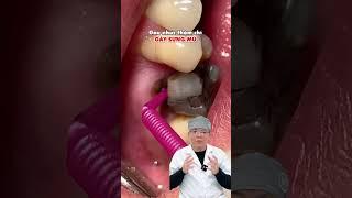 Cô chú nào có đang gặp tình trạng trên không ?  #cayghepimplant #nhakhoa#implant #moncorang