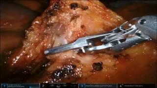 Robotic Complete Mesocolic Excision with “Top to Down-No Touch” Technique for Right Colon Cancer