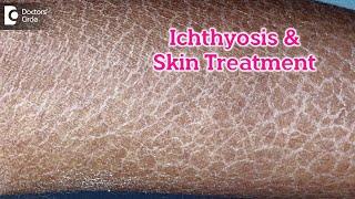 What is Ichthyosis? How to Treat my Skin? Fish like scales On Skin-Dr.Rasya Dixit  Doctors Circle