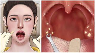 ASMR Cause of bad breath Tonsil stone removal animation