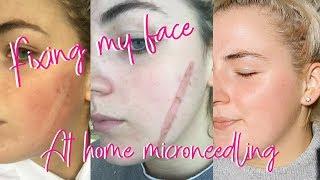 Getting rid of my scar At home microneedling & mini facial using the Nu Skin Galvanic Spa 2