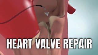 Heart Valve Repair percutaneous or endovascular access