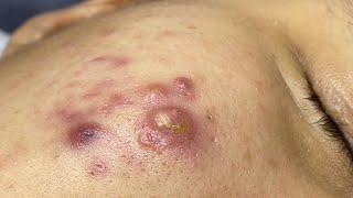 Satisfying With Loan Nguyen Spa Video #064 #acnetreatment