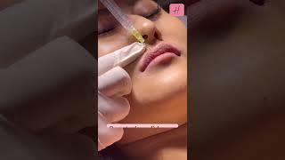 Improved Lip Shape by Fillers Live Procedure  #shorts #shortsfeed #lipfiller