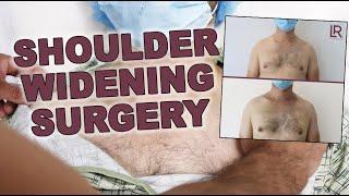 Shoulder Widening Clavicle Lengthening Surgery  Dr. Leif Rogers