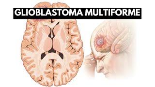 Inside Glioblastoma Multiforme A Journey into the Deadliest Brain Tumor