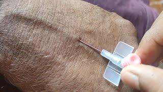 Cannulation Cannula kaise lgaye Cannulation technique #cannula #intravenous #trending #viral