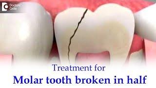 Back toothMolar tooth broke in half inside. What to do? - Dr. Ranjani Rao  Doctors Circle