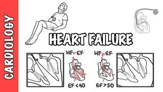 Heart failure with reduced and preserved ejection fraction pathophysiology and treatment