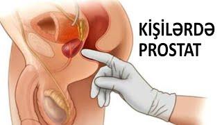 Kişilərdə prostat - Xərçəngə çevrilir?