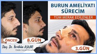 BURUN AMELİYATI SÜRECİM   TÜM MERAK EDİLENLER Kapalı Burun Estetiği Doc. Dr. İbrahim Aşkar