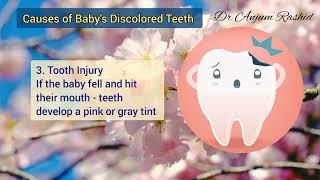 Baby Teeth Discolored - Causes & Solution  Newborn Caring Tips