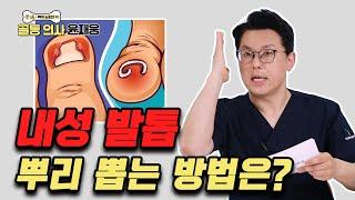 자꾸 재발하는 ‘내성 발톱’ 이렇게 치료하세요 - 골통 의사 윤재웅 #69 내성발톱