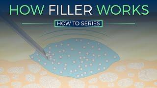 How Dermal Fillers Work - HOW TO SERIES