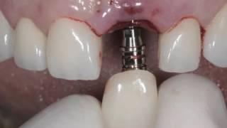 Implante Imediato em Área Estética   Immediate Implant in the Esthetic Zone