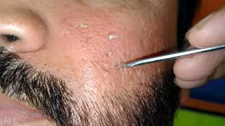 blackheads removal sac dep spa 2024  How to remove blackheads from ears  asghar barbershop 446