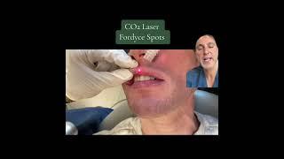 Lip Fordyce Spots Removal with CO2 Laser -