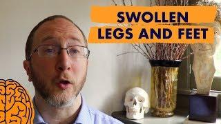 Multiple Sclerosis Symptoms Video Swollen Legs and Feet